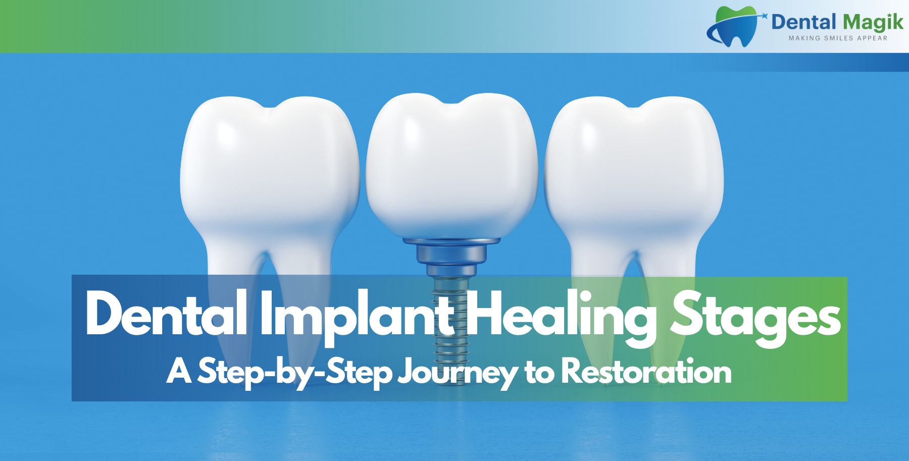 Dental Implant Healing Stages: A Step-by-Step Journey to Restoration