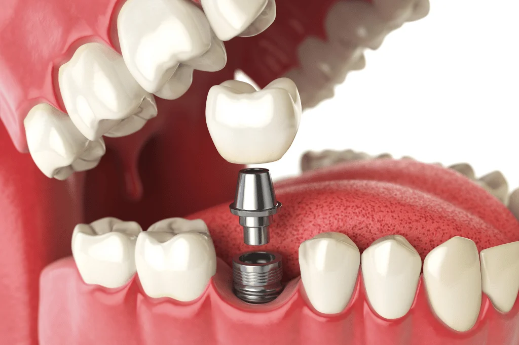 Dental Implants in East Brunswick, NJ