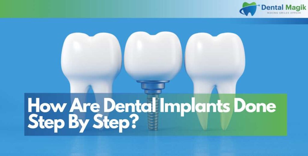 How Are Dental Implants Done Step By Step