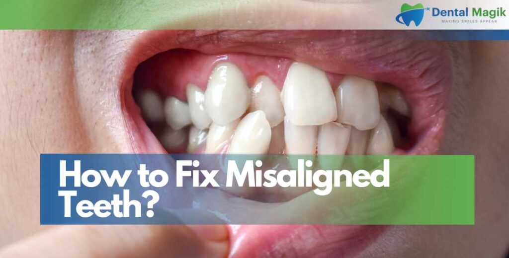 How to Fix Misaligned Teeth?