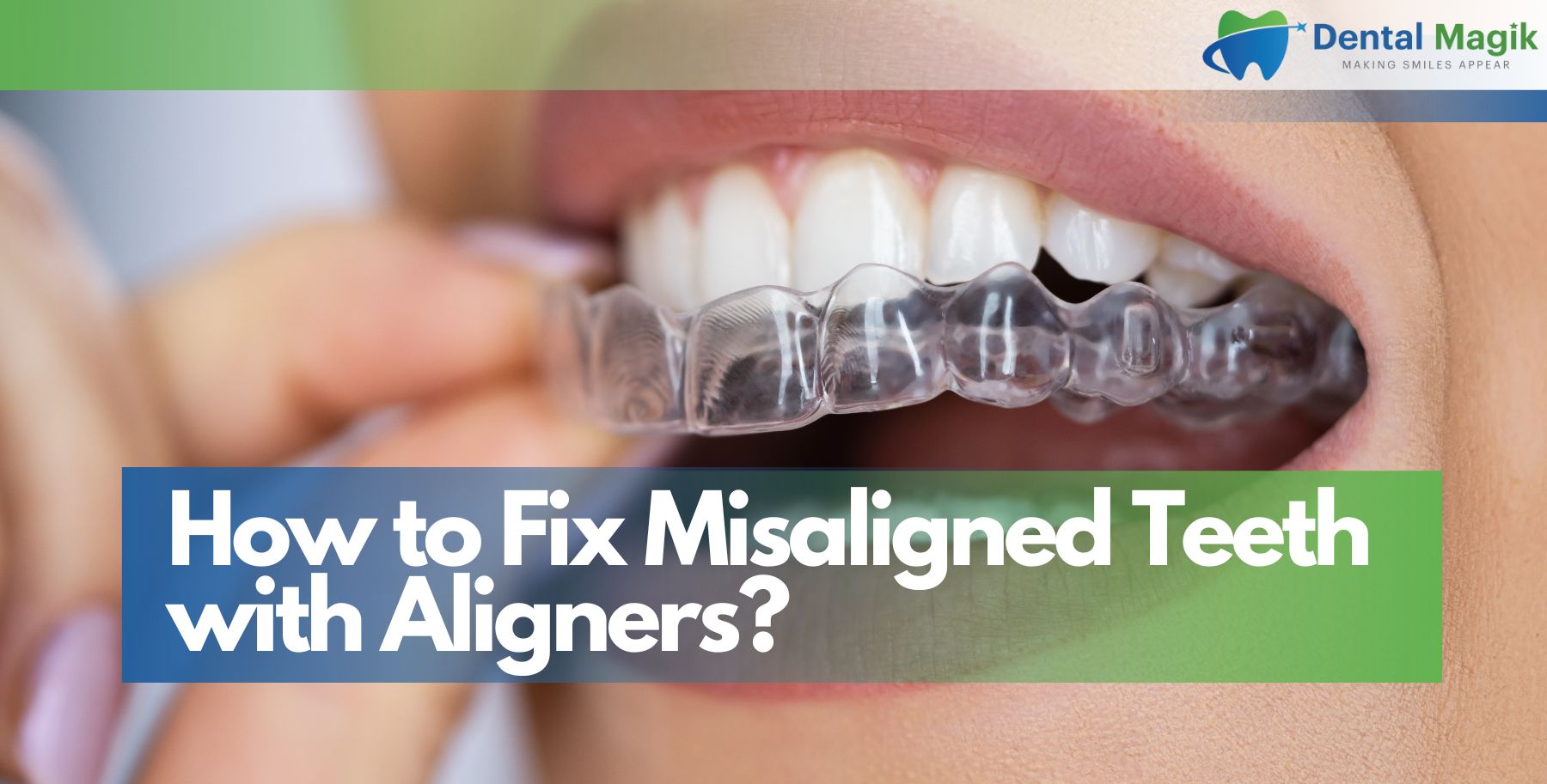 How to Fix Misaligned Teeth with Aligners?