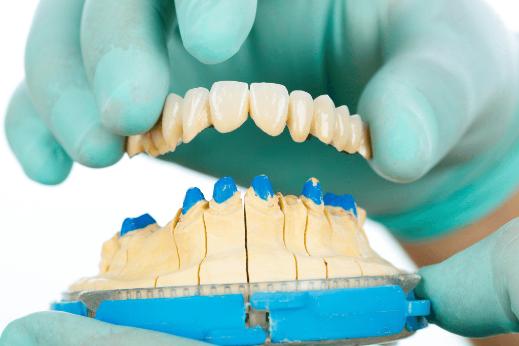 Porcelain Dental Bridges