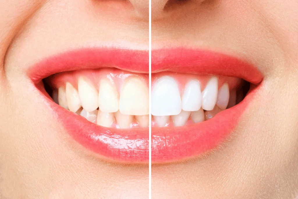 Teeth Whitening in East Brunswick, NJ