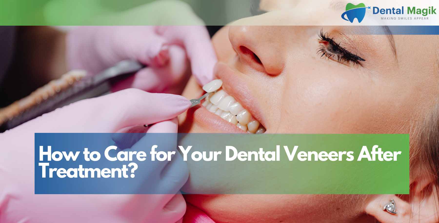 How to Care for Your Dental Veneers After Treatment?