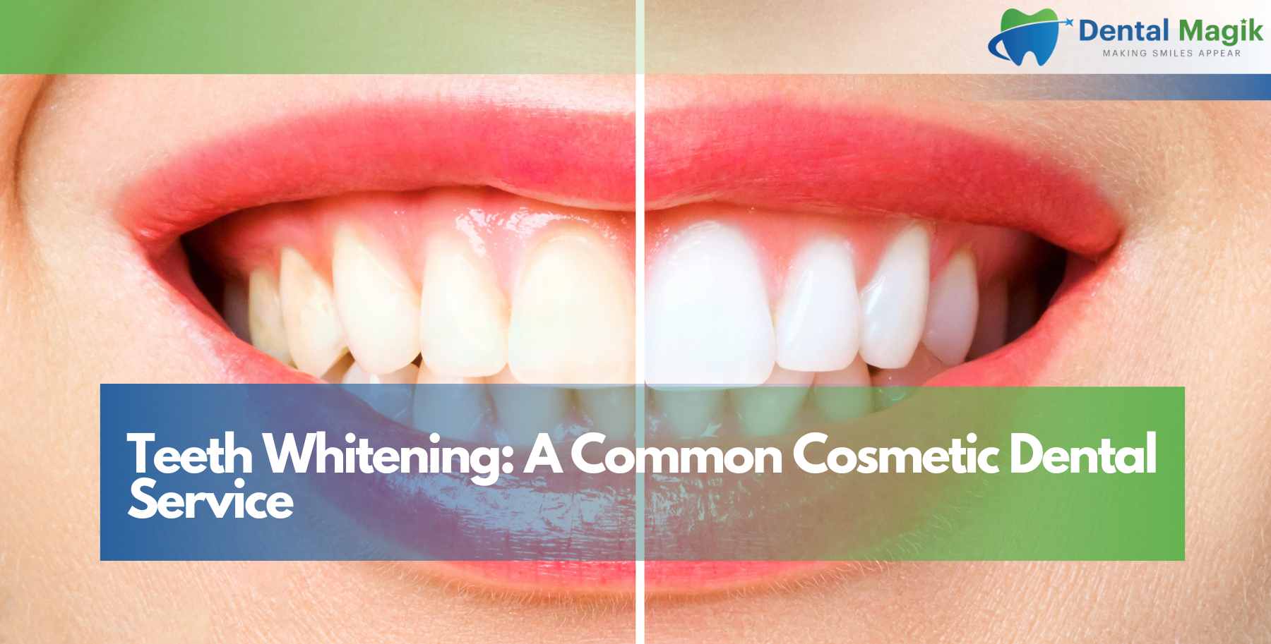 Teeth Whitening: A Common Cosmetic Dental Service