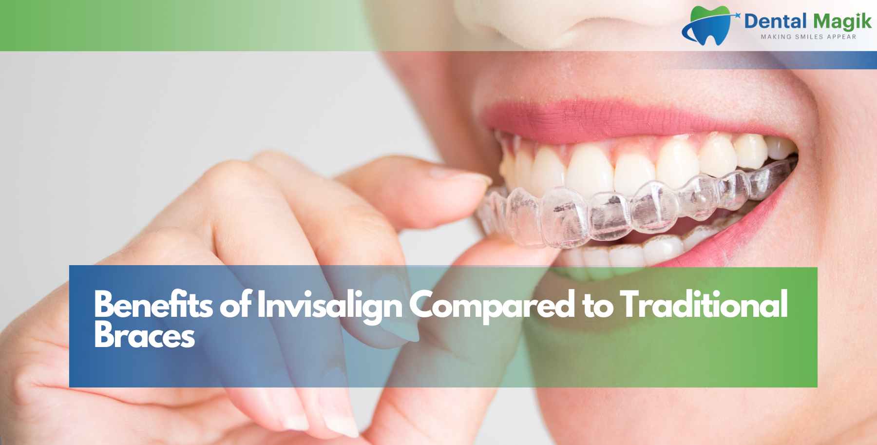 Benefits of Invisalign Compared to Traditional Braces