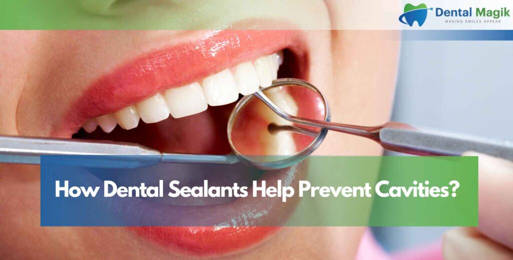 How Dental Sealants Help Prevent Cavities?