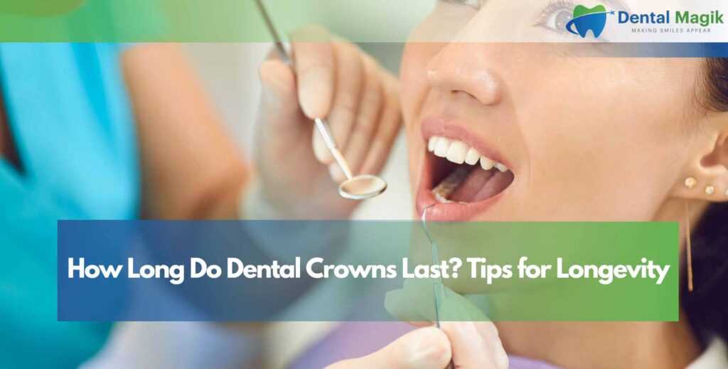 How Long Do Dental Crowns Last? Tips for Longevity