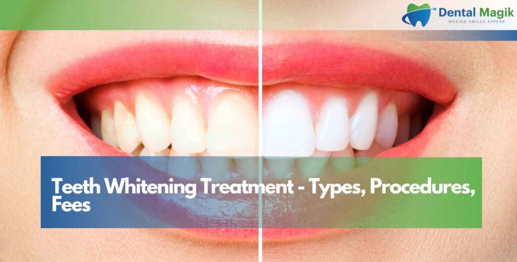 Teeth Whitening Treatment - Types, Procedures, Fees