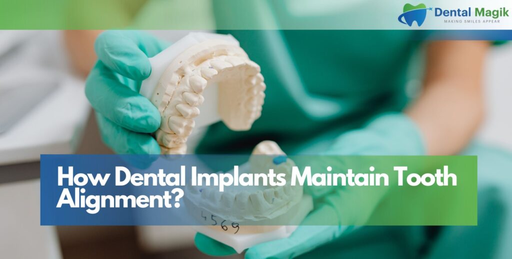 How Dental Implants Maintain Tooth Alignment?