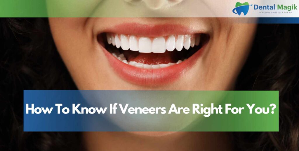 How To Know If Veneers Are Right For You?