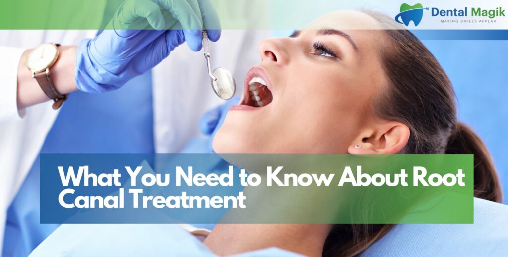What You Need to Know About Root Canal Treatment