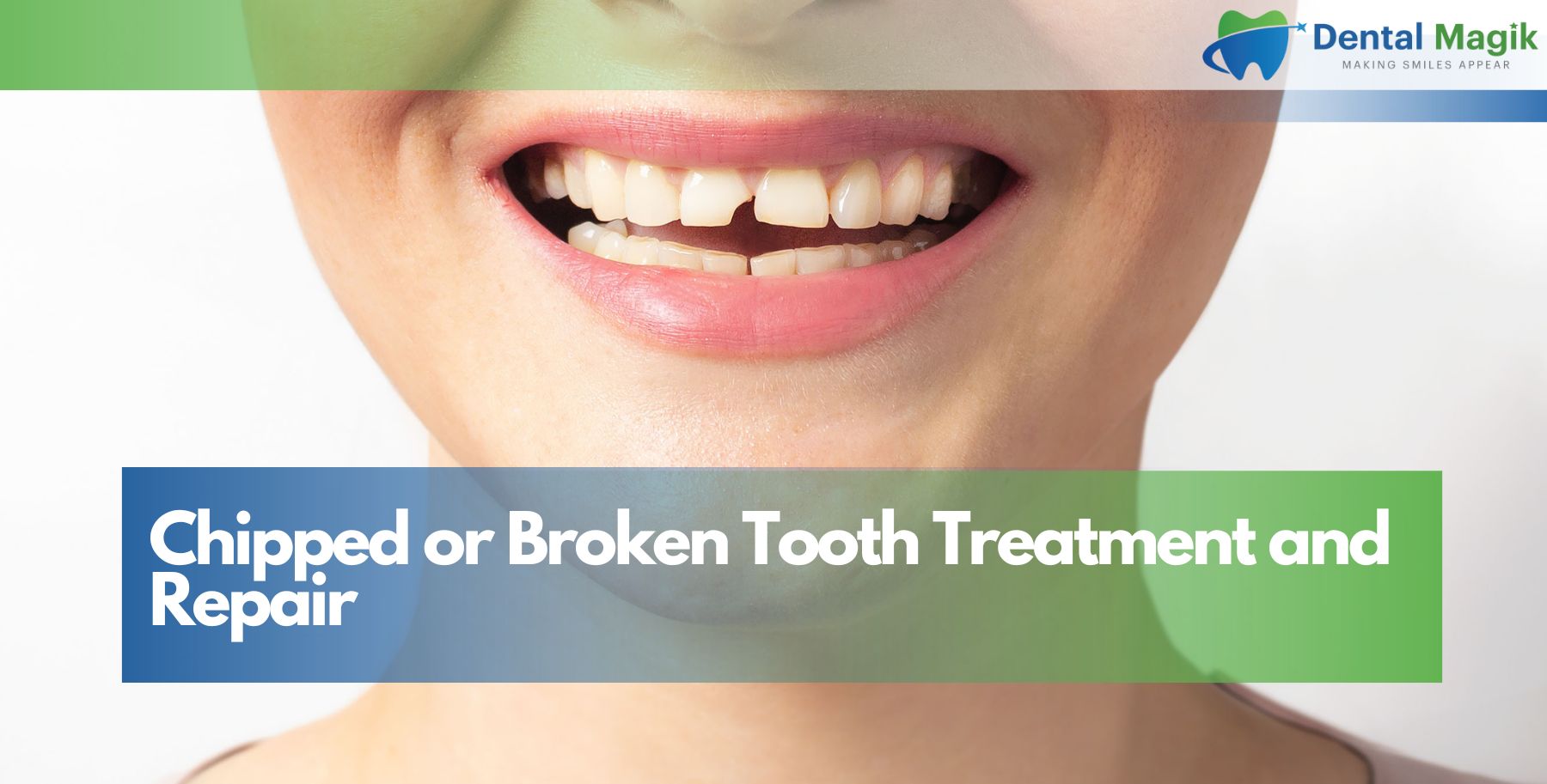 Chipped or Broken Tooth Treatment and Repair