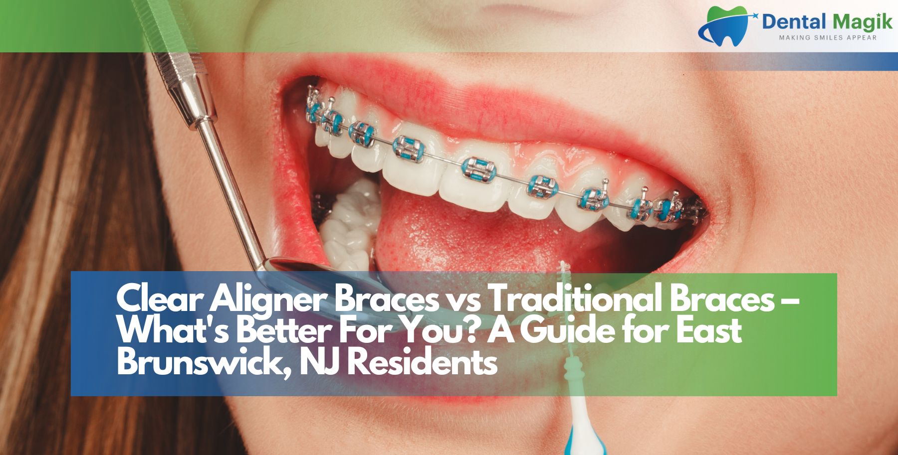 Clear Aligner Braces vs Traditional Braces