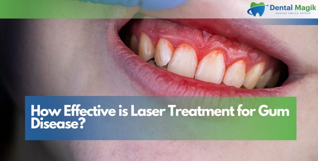 How Effective is Laser Treatment for Gum Disease?