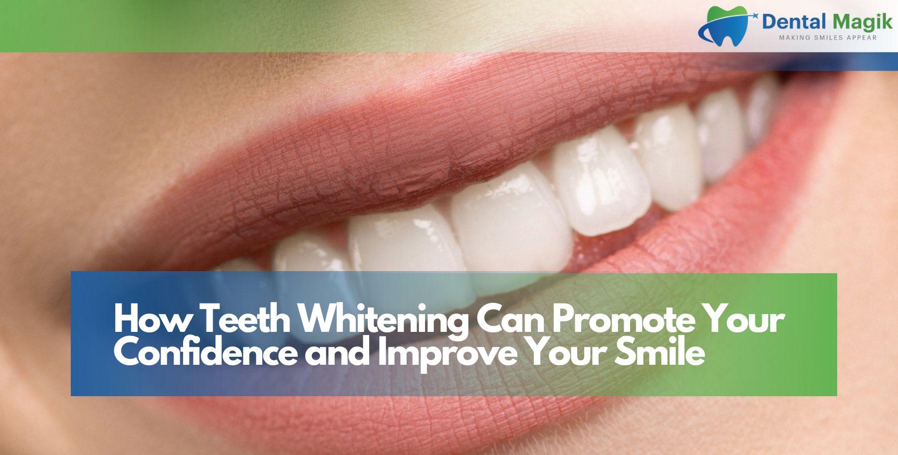 How Teeth Whitening Can Promote Your Confidence and Improve Your Smile