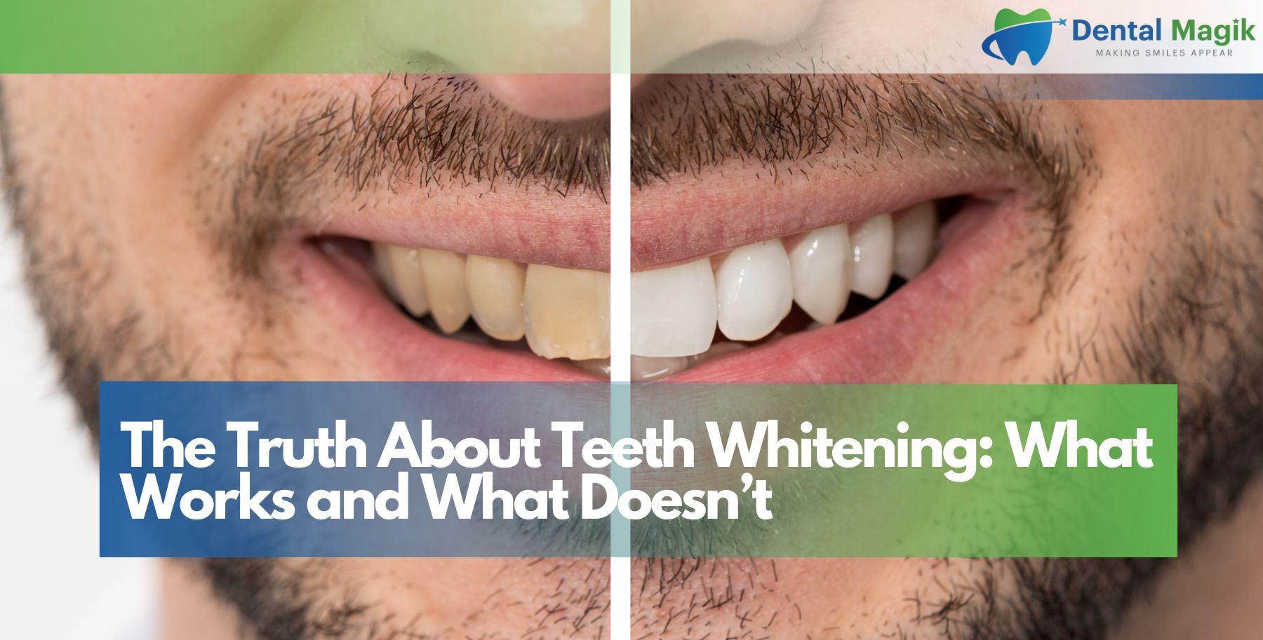 The Truth About Teeth Whitening: What Works and What Doesn’t