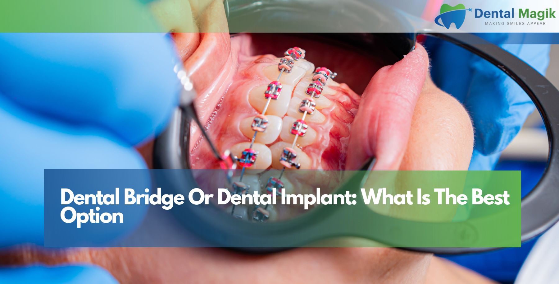 Dental Bridge Or Dental Implant: What Is The Best Option