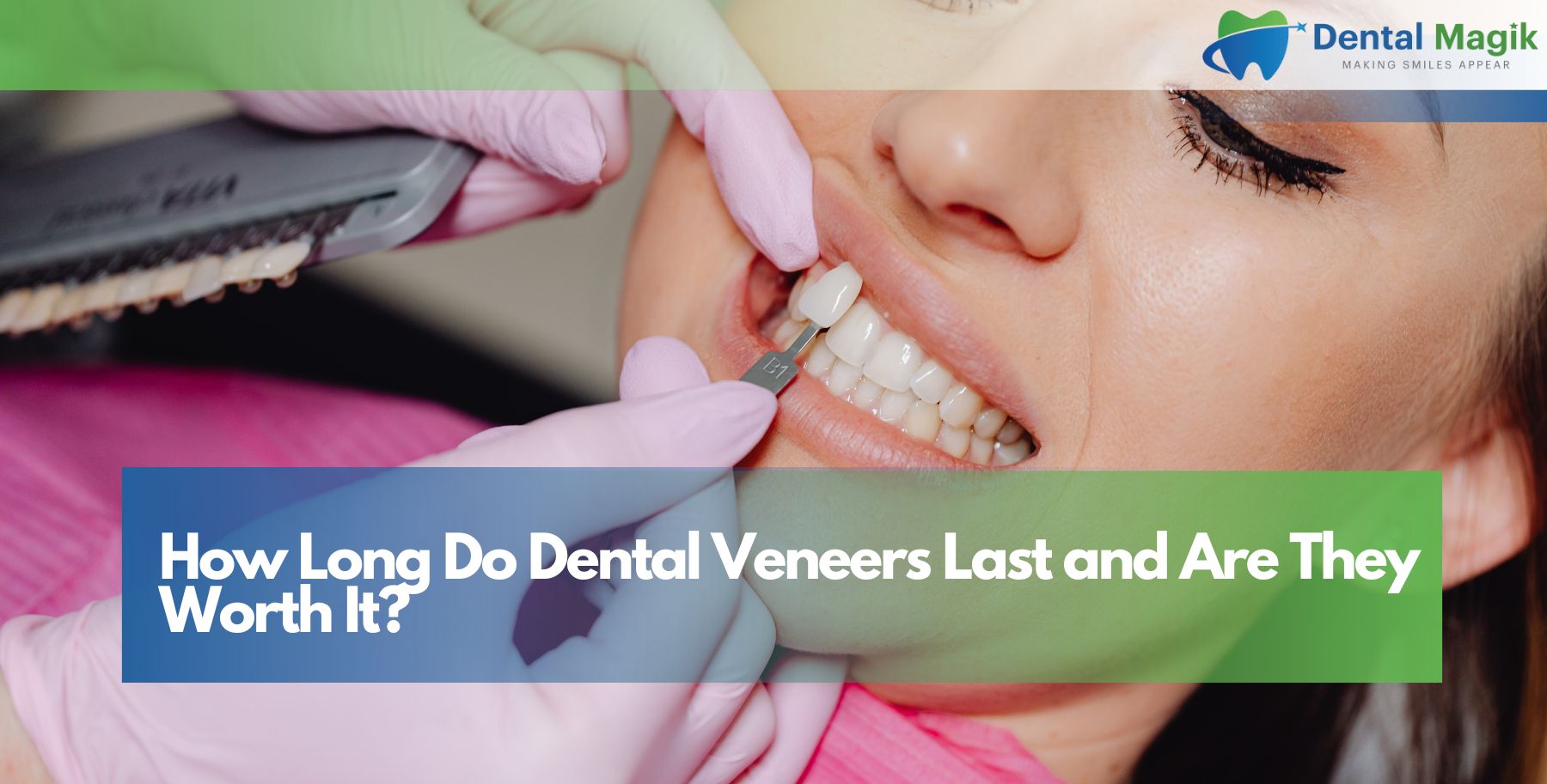How Long Do Dental Veneers Last and Are They Worth It?