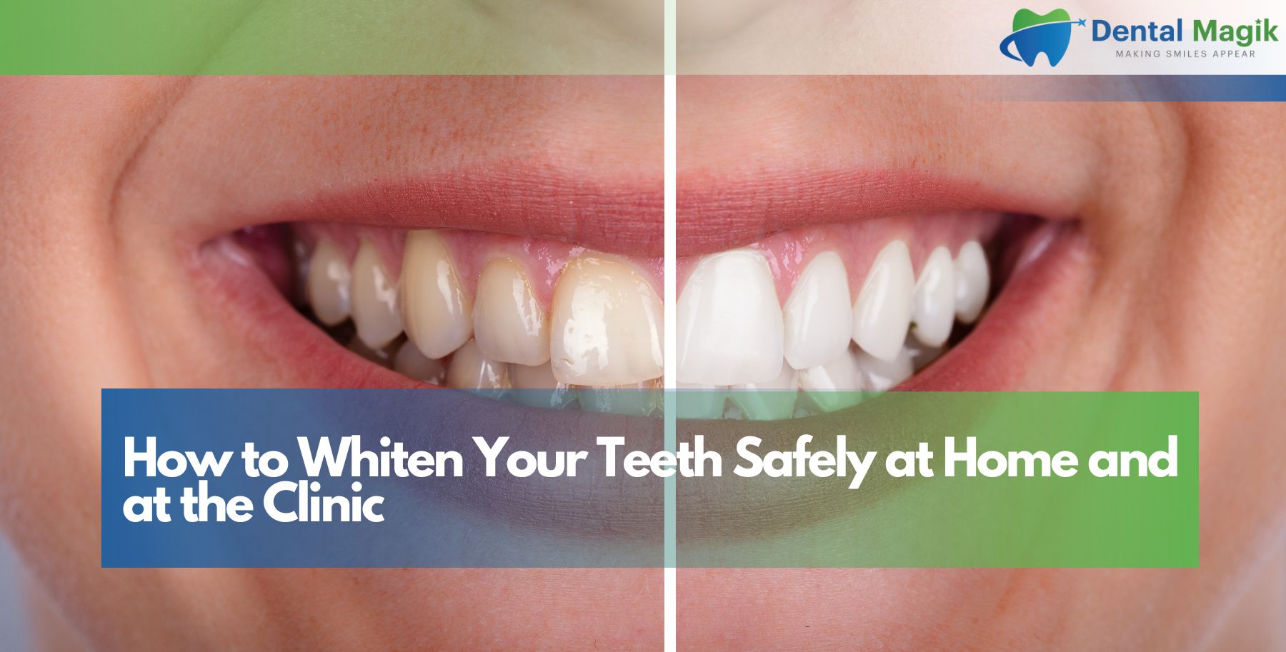 How to Whiten Your Teeth Safely at Home and at the Clinic