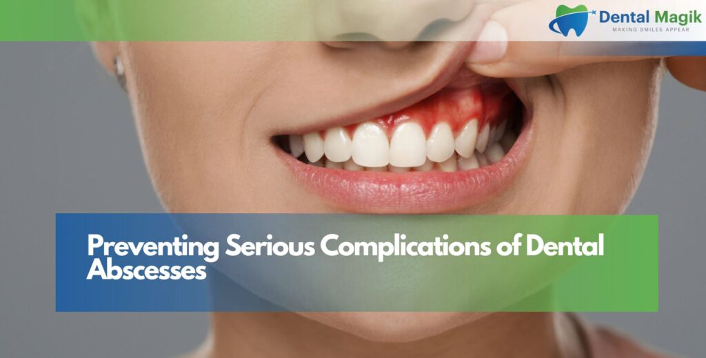 Preventing Serious Complications of Dental Abscesses