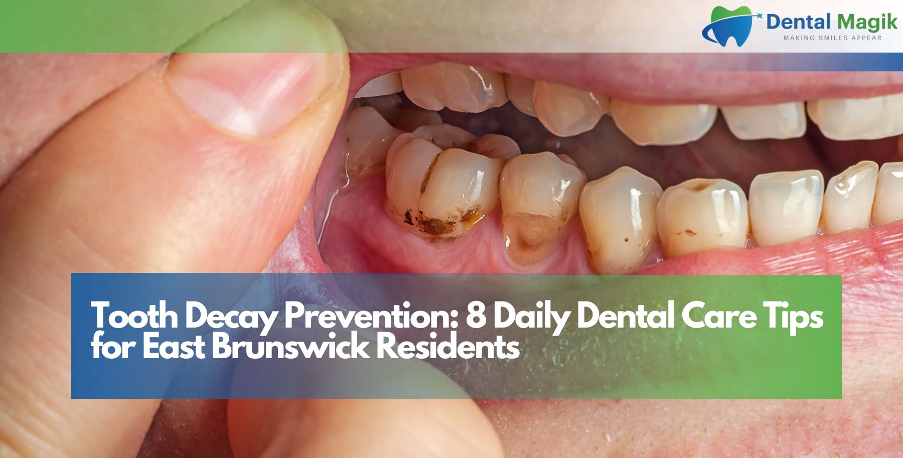 Tooth Decay Prevention