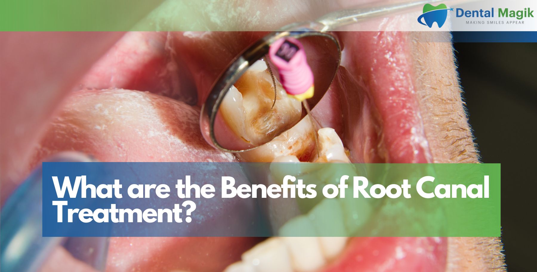 What are the Benefits of Root Canal Treatment?