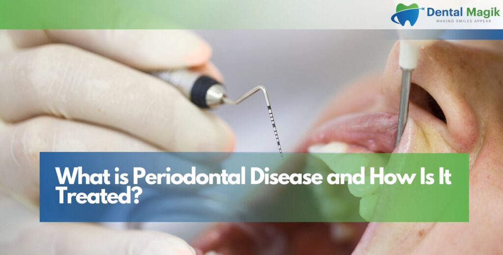 What is Periodontal Disease and How Is It Treated?