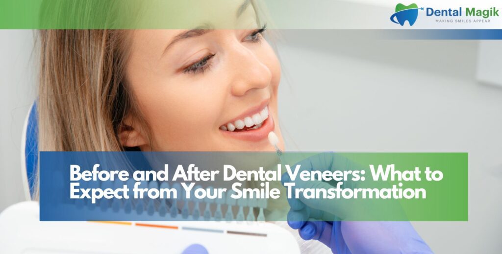 Before and After Dental Veneers