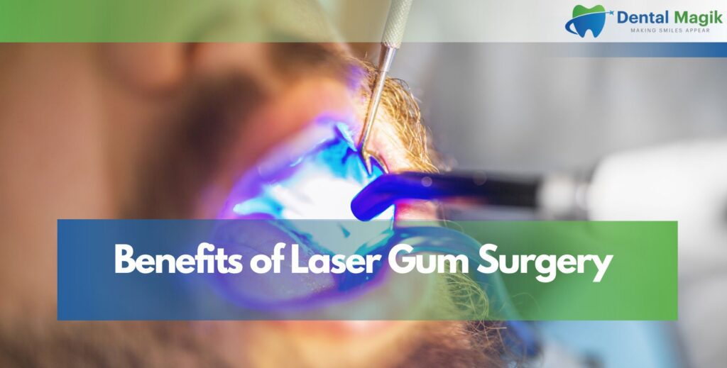 Benefits of Laser Gum Surgery