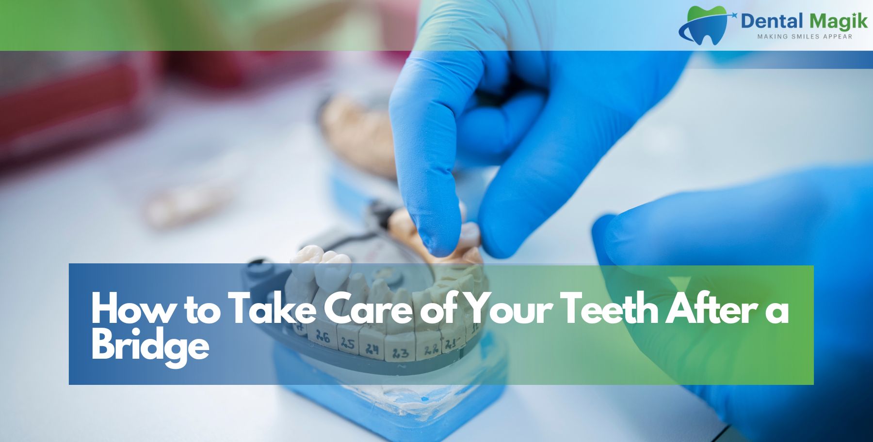 How to Take Care of Your Teeth After a Bridge