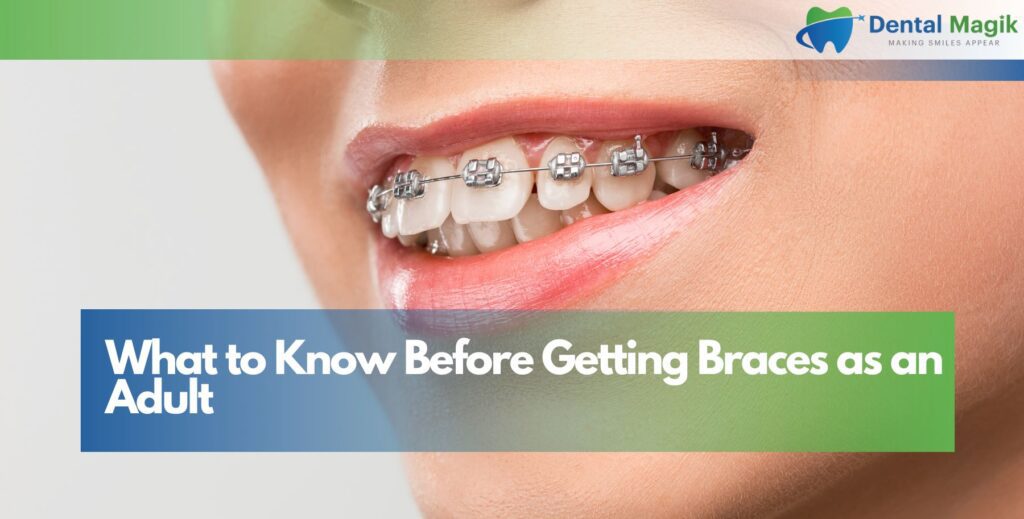 What to Know Before Getting Braces as an Adult