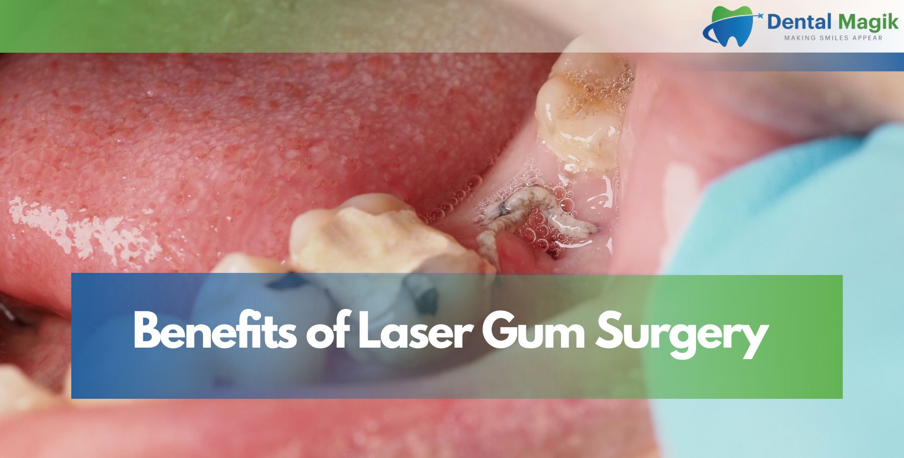 Benefits of Laser Gum Surgery