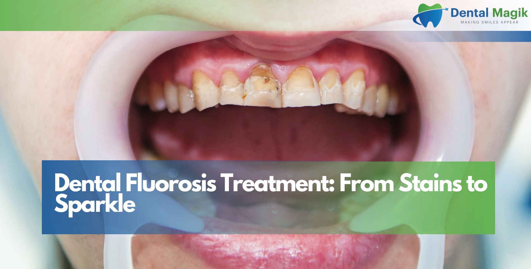 Dental Fluorosis Treatment: From Stains to Sparkle