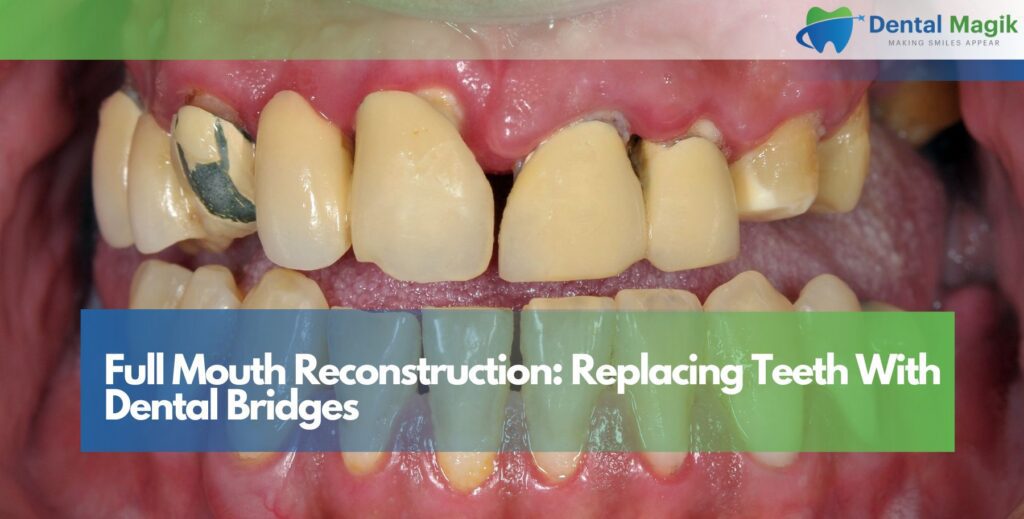 Full Mouth Reconstruction: Replacing Teeth With Dental Bridges