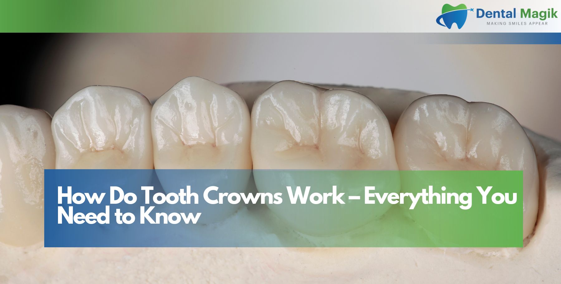 How Do Tooth Crowns Work