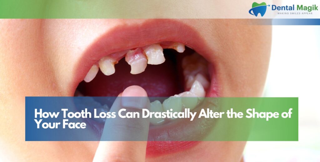 How Tooth Loss Can Drastically Alter the Shape of Your Face