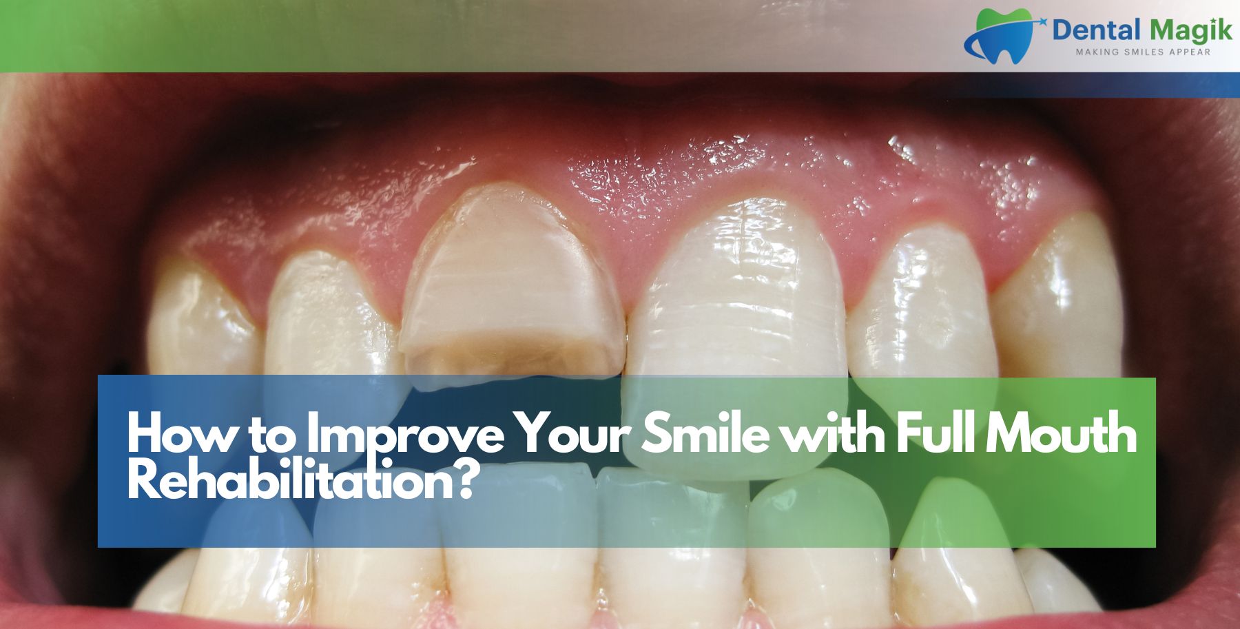 How to Improve Your Smile with Full Mouth Rehabilitation?