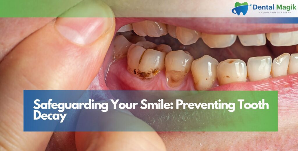 Safeguarding Your Smile: Preventing Tooth Decay