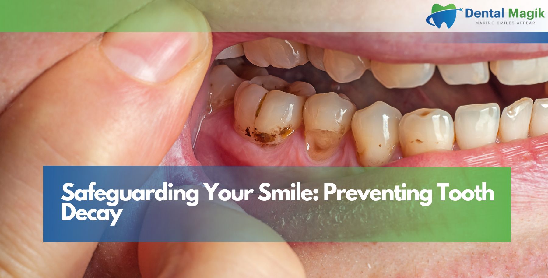Safeguarding Your Smile: Preventing Tooth Decay