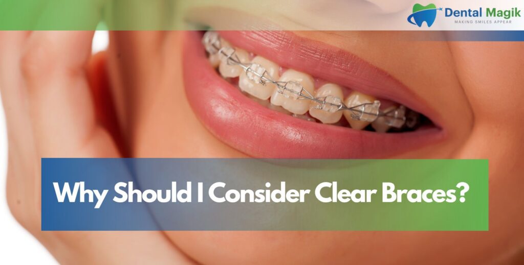Why Should I Consider Clear Braces?