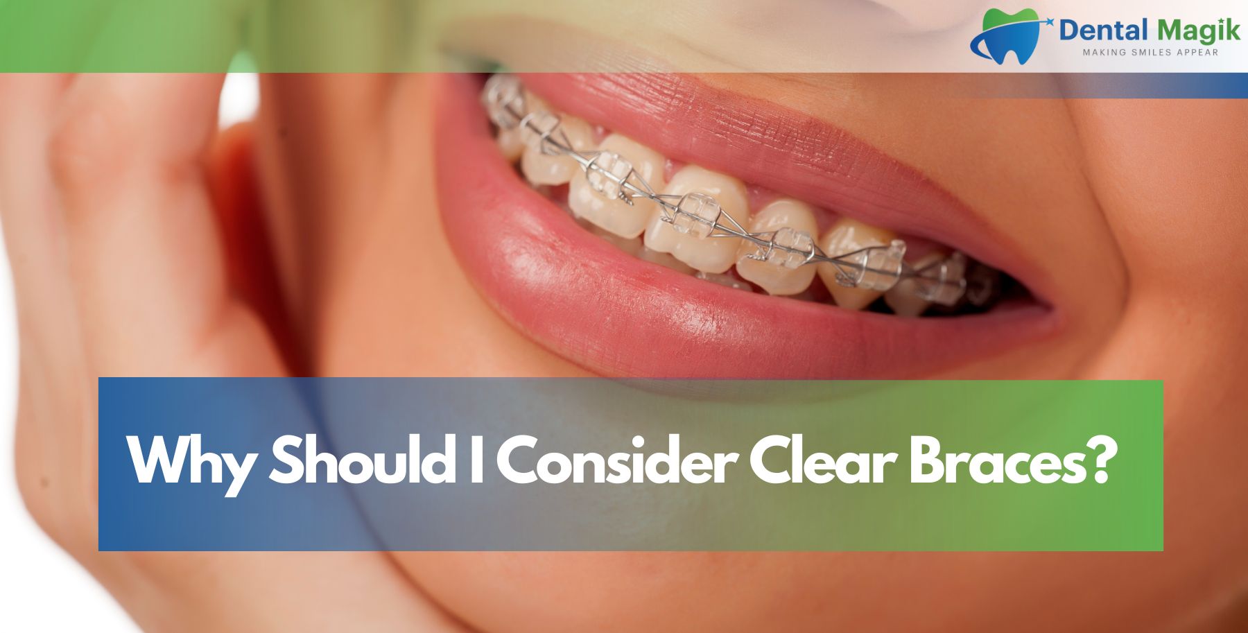 Why Should I Consider Clear Braces?