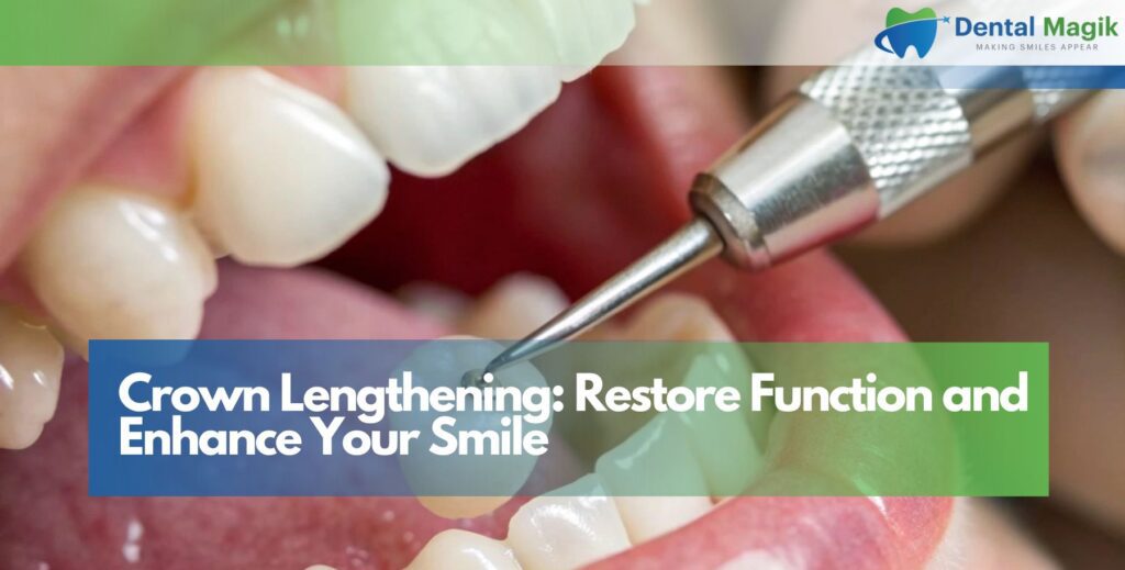 Crown Lengthening: Restore Function and Enhance Your Smile
