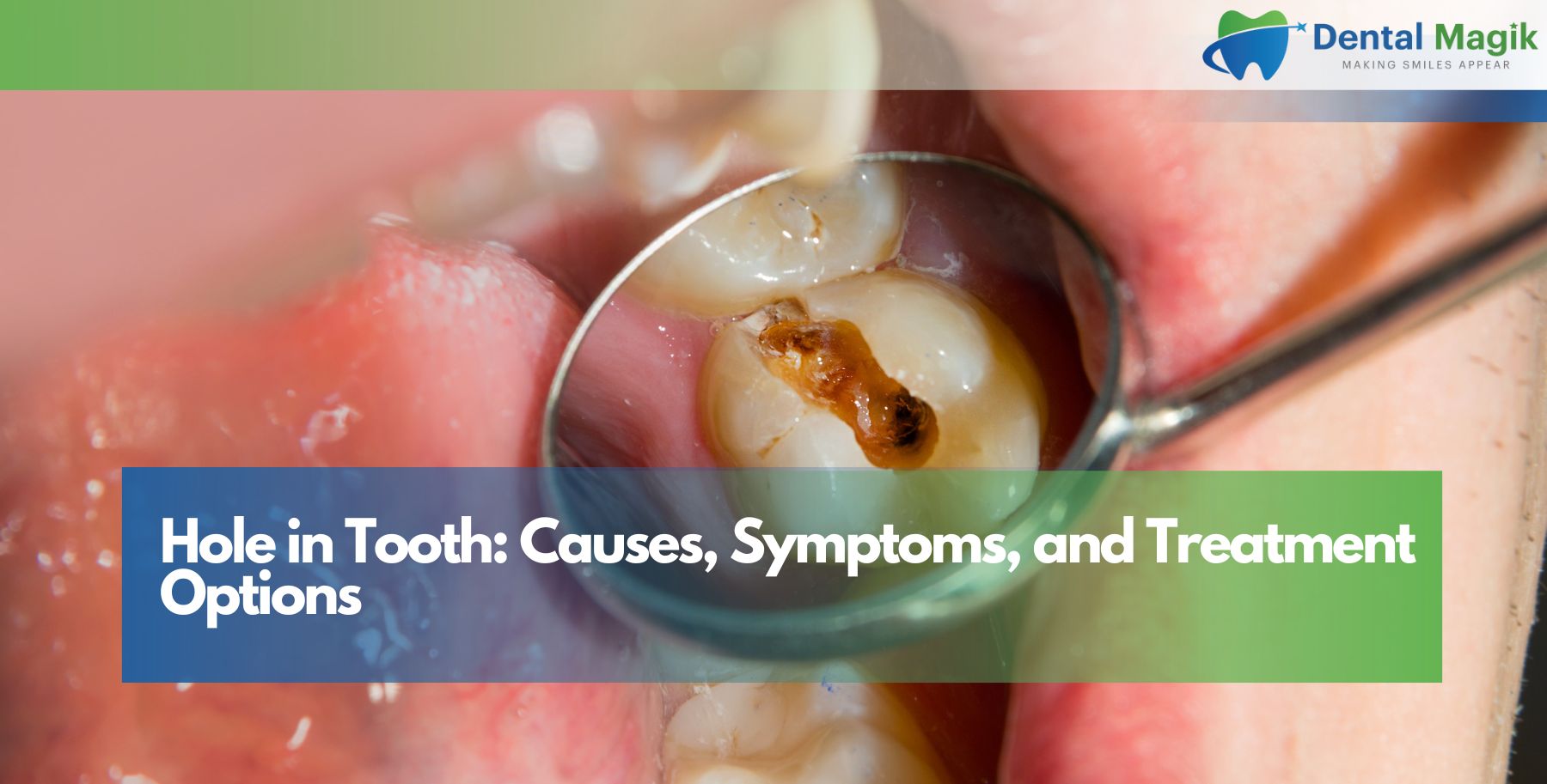Hole in Tooth: Causes, Symptoms, and Treatment Options