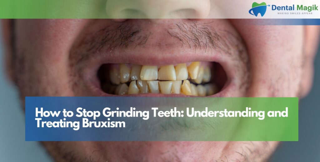 How to Stop Grinding Teeth: Understanding and Treating Bruxism