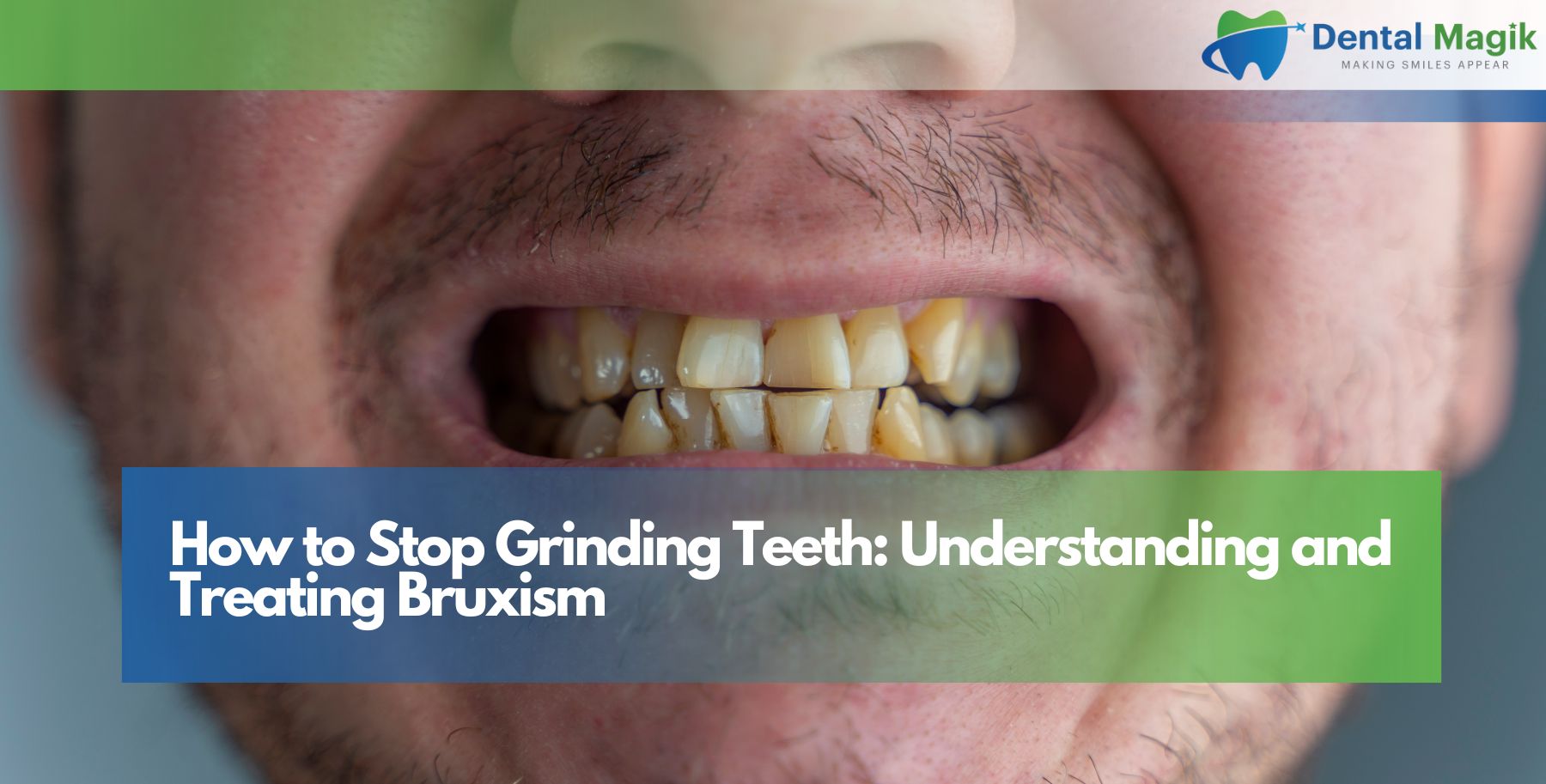 How to Stop Grinding Teeth: Understanding and Treating Bruxism