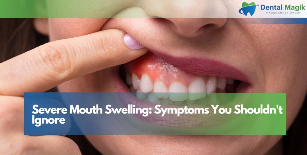 Severe Mouth Swelling: Symptoms You Shouldn't Ignore