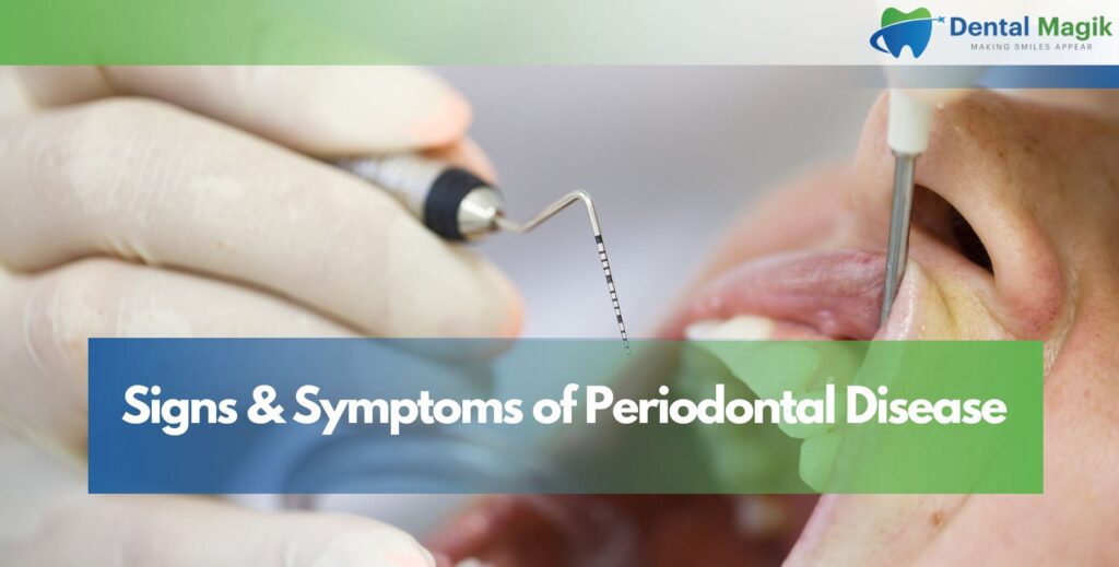 Signs & Symptoms of Periodontal Disease