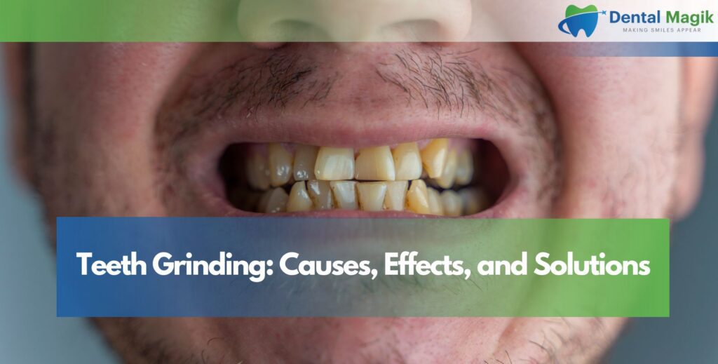 Teeth Grinding: Causes, Effects, and Solutions