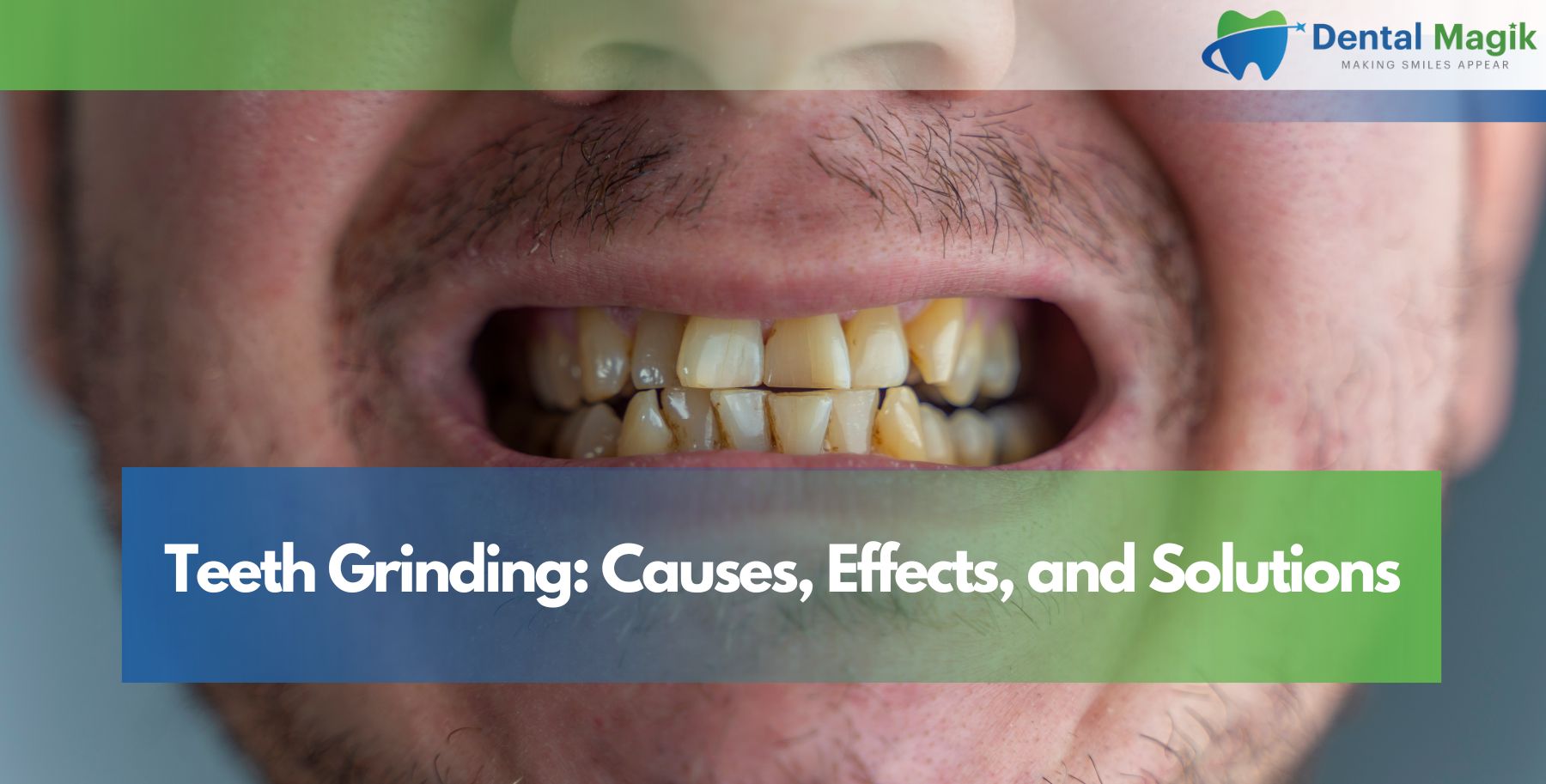 Teeth Grinding: Causes, Effects, and Solutions
